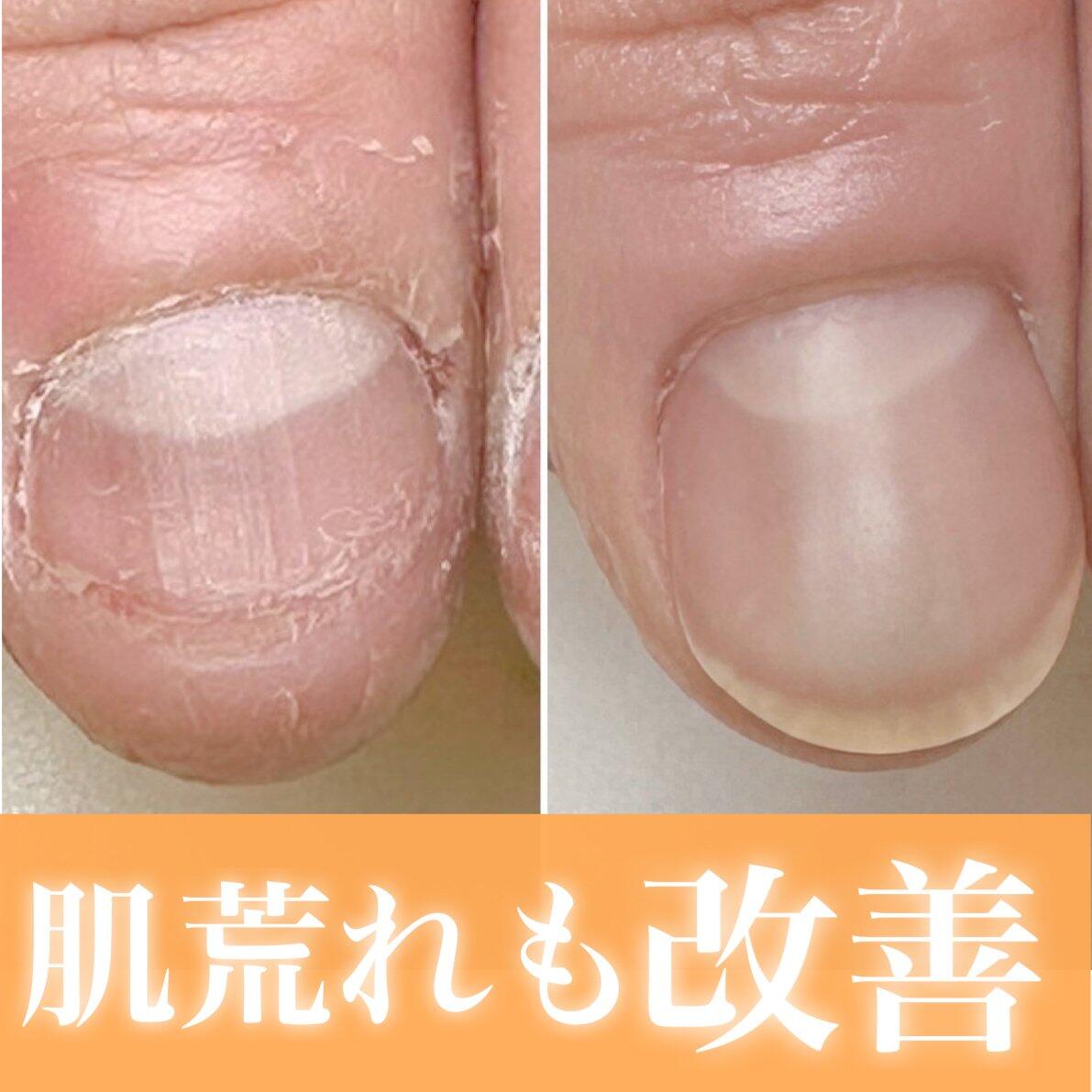 深爪矯正しながら美肌ケア