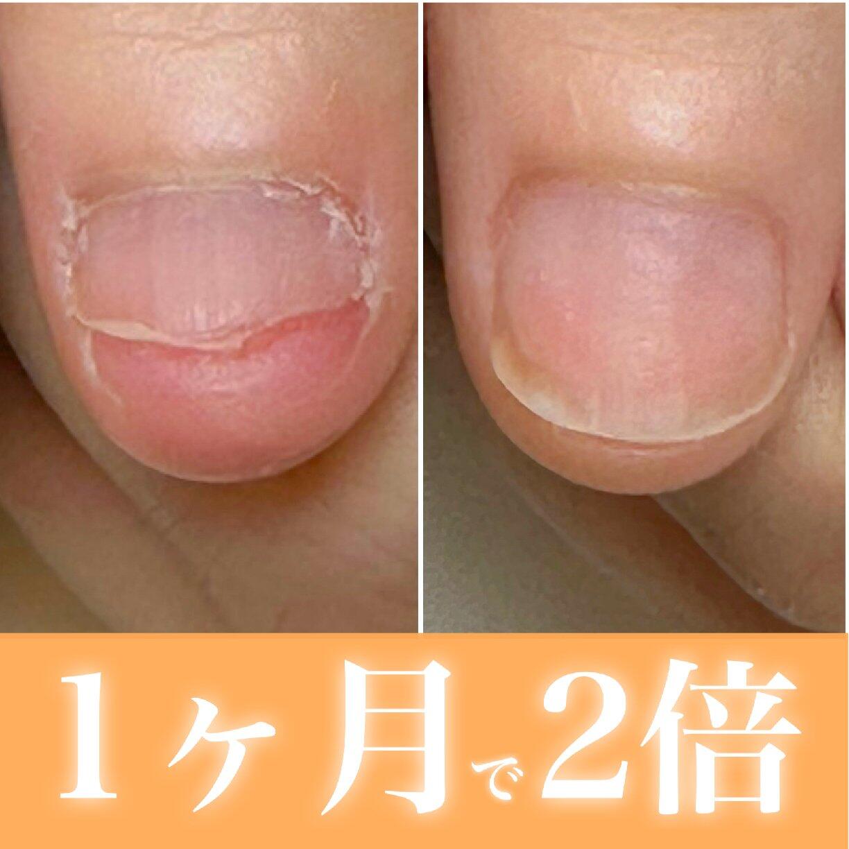 深爪から理想の縦長爪へ