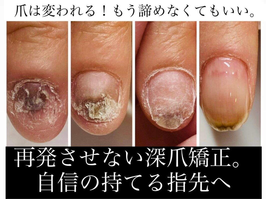 重度の深爪にも対応◎