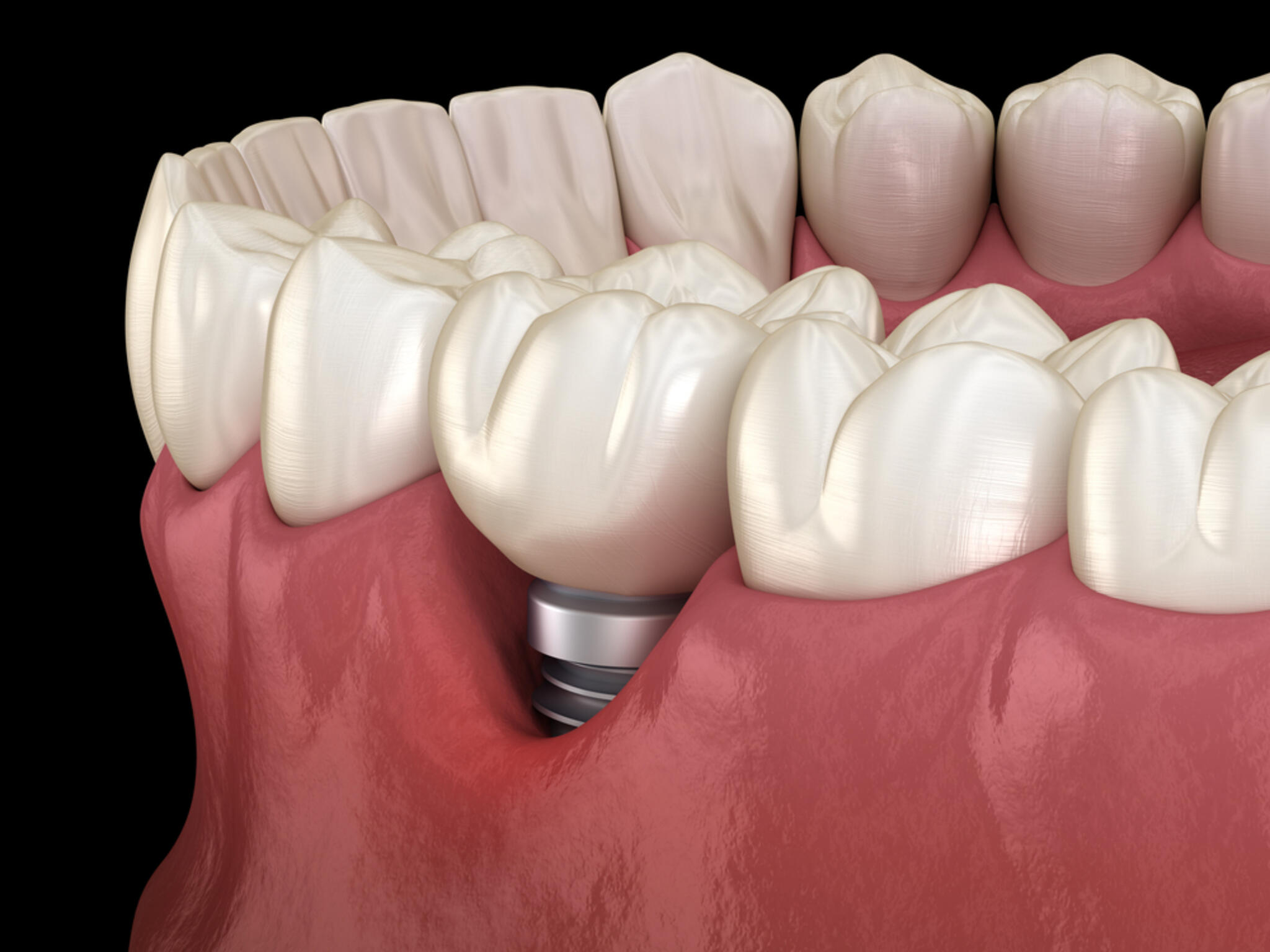 かみむら歯科・矯正歯科クリニックからのお知らせ(インプラントの天敵、インプラント周囲炎とは)に関する写真