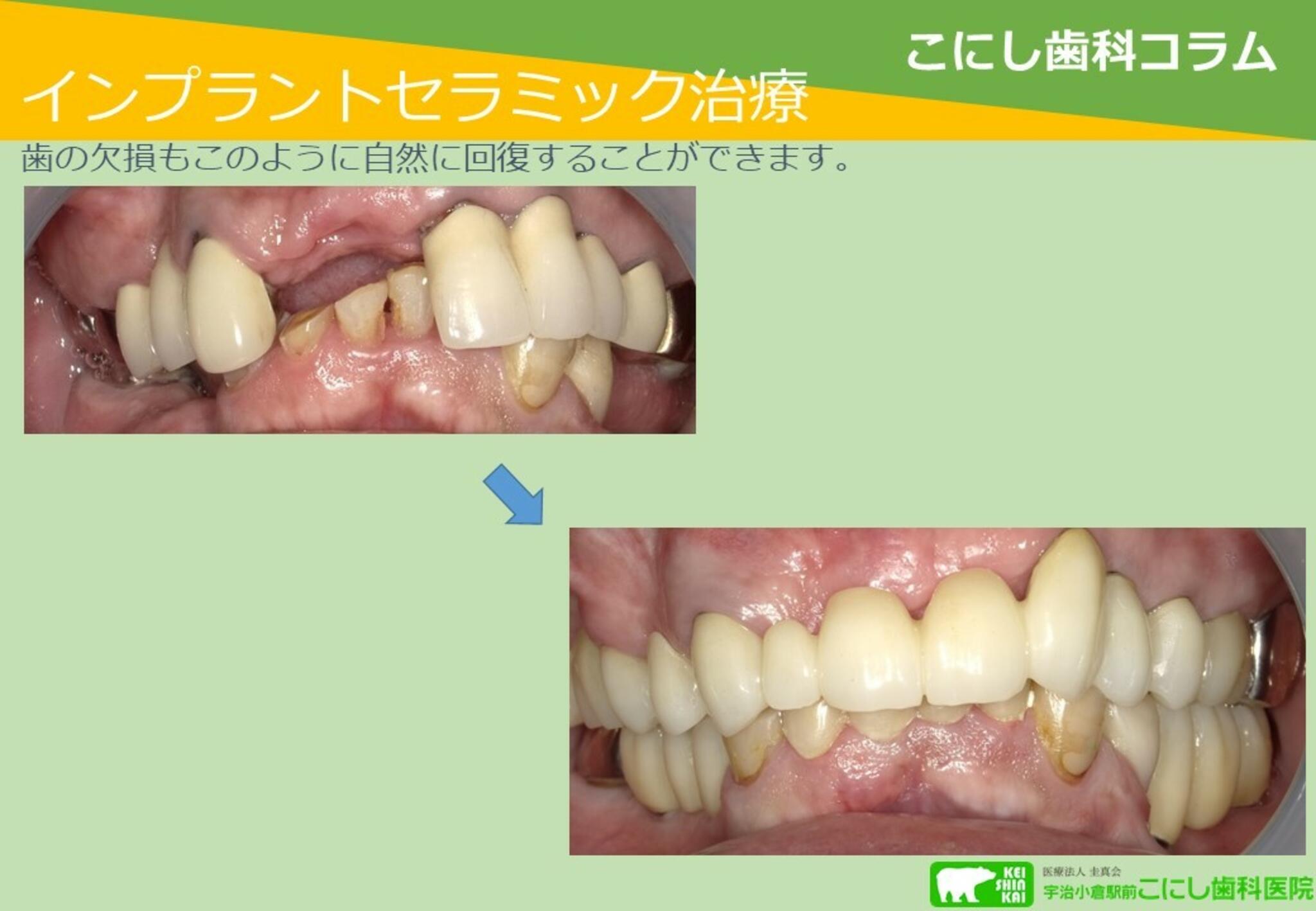 宇治小倉駅前 こにし歯科医院からのお知らせ(インプラントとセラミック治療)に関する写真