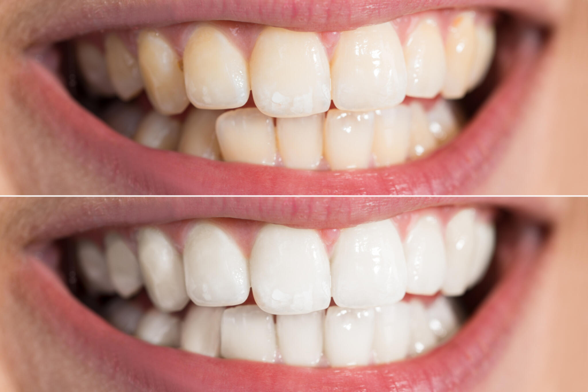 かみむら歯科・矯正歯科クリニックからのお知らせ(ホームホワイトニングとオフィスホワイトニングの違いとは？)に関する写真