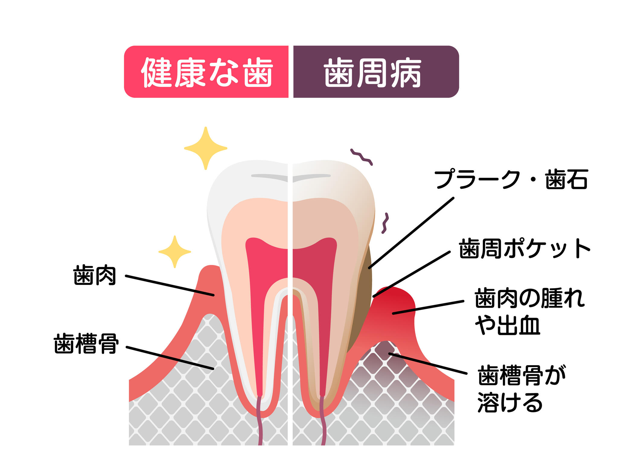 かみむら歯科・矯正歯科クリニックからのお知らせ(歯周病の原因)に関する写真